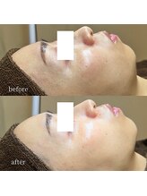 アーネスト 大阪心斎橋店(EARNEST)/泡＋水光【 肌乾燥・シワ 】