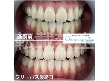 ホワイトニングサロン 福岡天神店/ホワイトニング