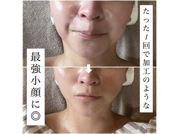 アンリミット(Unlimit)/小顔施術1回のビフォーアフター
