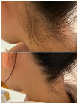 ココピュアレ(coco purele)/気になるうなじの脱毛☆