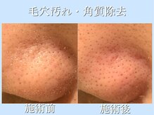 リブ(LIB)/毛穴洗浄ウォーターピーリング8