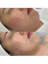 千歳の女神 久屋大通店/【施術風景】Berore/After