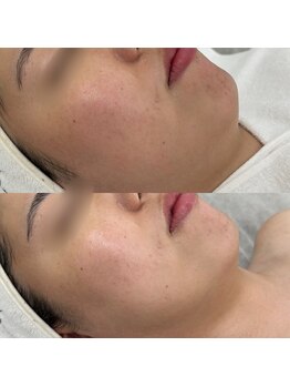 千歳の女神 久屋大通店/【施術風景】Berore/After