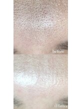 クレヴィー(Creviy)/潤艶wax脱毛(産毛脱毛)1回施術