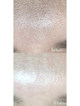 クレヴィー(Creviy)/潤艶wax脱毛(産毛脱毛)1回施術