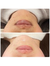 ラヴィ(Ravi)/同じところに繰り返すニキビケア