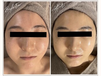 ミューベル(MYubelle)/水光肌に♪水光ピーリング1回後