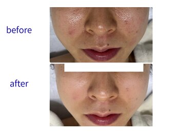 ビオール 池袋店(beall)/全顔丸ごとフェイシャルコース