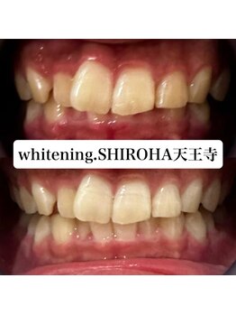 シロハ(SHIROHA)/セルフホワイトニング/天王寺