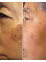 長寿鍼灸院 長寿整骨院/美容鍼50本の効果★くすみ改善