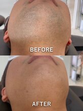 ジェンヌ(jenne.)/好印象☆ヒゲ脱毛