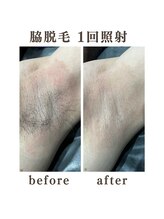 ボゴス(BOGOSS)/【ワキ脱毛】施術写真