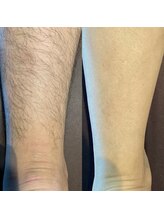 リベルテ(Liberte)/全身脱毛+顔脱毛