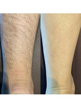 リベルテ(Liberte)/全身脱毛+顔脱毛