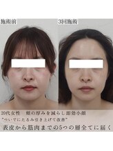 ヴェルシック(Belchic)/真皮から筋肉まで5つの層へ届く