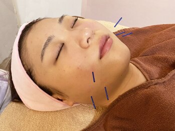 ほほあげ専門 チークアップラボの写真/【美容鍼チークアップコース¥7700→初回¥5000】日本で希少＊お顔のリフトアップ専門店♪お肌のお悩み解消☆