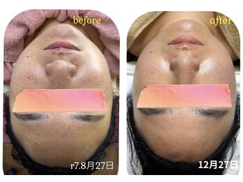 シェービング アンド エステ ローズマリー(Rosemary)/☆光フォト☆