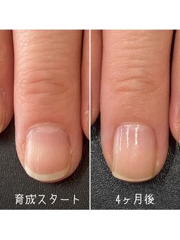 ネイルズ アヴァンティ(Nails Avanti)/割れやすい爪を育成4ヶ月コース