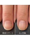 割れやすい爪を育成4ヶ月コース