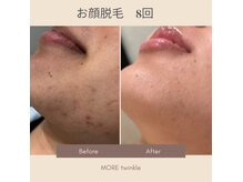 モアトゥインクル 福山宮通り店(MORE twinkle)の雰囲気（脱毛しながら肌改善(^^)自信が持てる美肌に☆#顔脱毛#ニキビ）