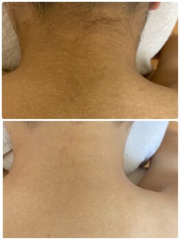 ココピュアレ(coco purele)/うなじ脱毛をしませんか?