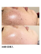 ルピナージュ(Lupinage)/【肌質改善】‐しみケア‐