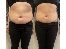 長寿鍼灸院 長寿整骨院/EMS＜お腹集中コース＞