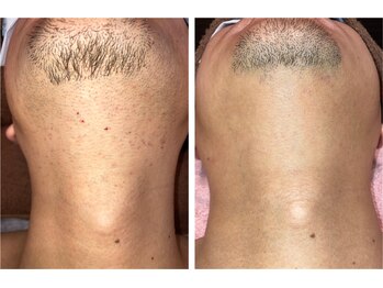 アネモネ ビューティーズ サロン(Anemone Beauty's salon)/ひげ脱毛　Before→After