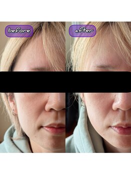 スノードロップ(snowdrop)/フェイシャルは小顔施術付き