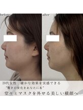 ヴェルシック(Belchic)/顎下のもたつき直後でもスッキリ