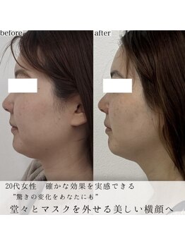 ヴェルシック(Belchic)/顎下のもたつき直後でもスッキリ