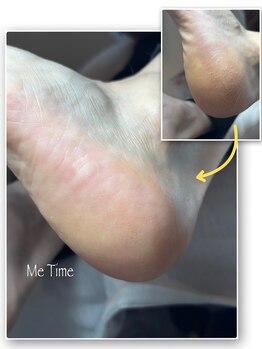 ミータイム(Me Time)/FOOT角質ケア