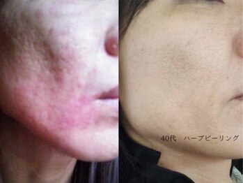 ボタニック 福津店(BoTANiC)/【ハーブピーリング】10回/40代