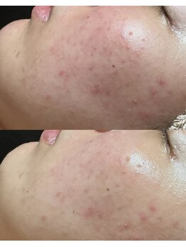 フィール(feel)/ビフォー アフター 1回施術