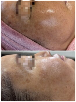 アズ(AZU)/シミ改善♪