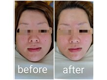 体験すれば違いがわかる！圧倒的技術力◎【美容鍼/美容鍼灸】