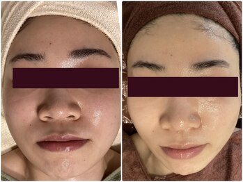 フォーユー 飯能店(Foryou)/セルマン 艶玉肌