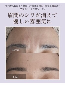 アイ(I)/眉間とおでこのシワ、たるみ改善