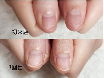 グラシナ なんば店/深爪/自爪育成/フィルイン