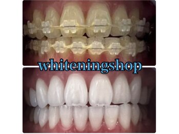 ホワイトニングショップ 鳳店/器具が付いている歯もOK