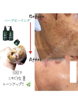 ルミナエステ(LUMINA ESTH)/ハーブピーリング/川口