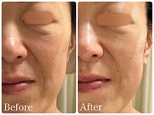 ロイヤル(ROYAL)/目元のシワ/たるみ改善症例