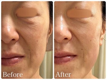 ロイヤル(ROYAL)/目元のシワ/たるみ改善症例