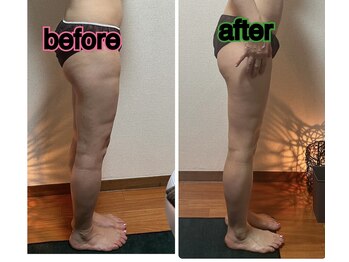 ナッツ(Nuts)/下半身痩せ【2回施術結果です】