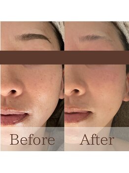 凪眠/小顔リンパフェイシャルの効果19