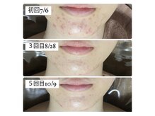 ホワイトアクア 池袋店(WHITE AQUA)/ハーブピーリング/毛穴洗浄/池袋