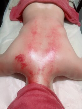 モア リフレッシュ 国分寺店(More Refresh)/かっさ、皮膚の表面特殊かっさ板