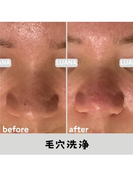 ルアナ 北谷店/毛穴洗浄毛穴ケア 《沖縄/北谷》