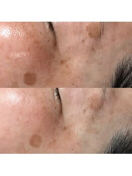 ハドゥ(Ha-DU)/シミケア20分間