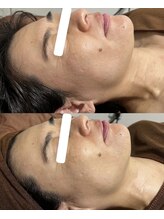 ヨルエステ(yoru aesthe)/【透明感up、首のシワケア】